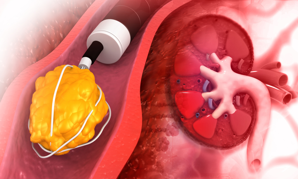 kidney treatment in indore