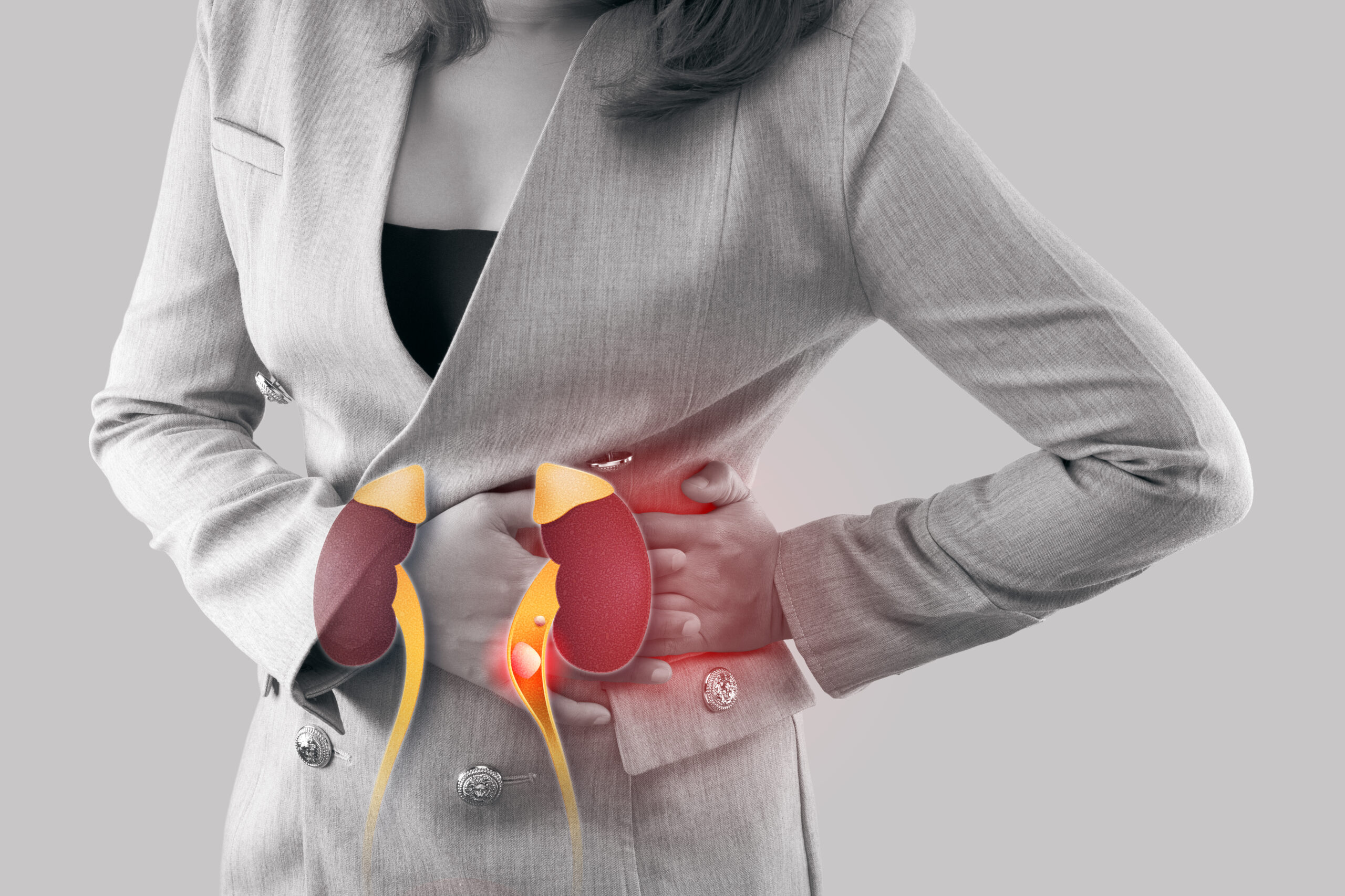 kidney stone causes