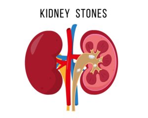 kidneys stone