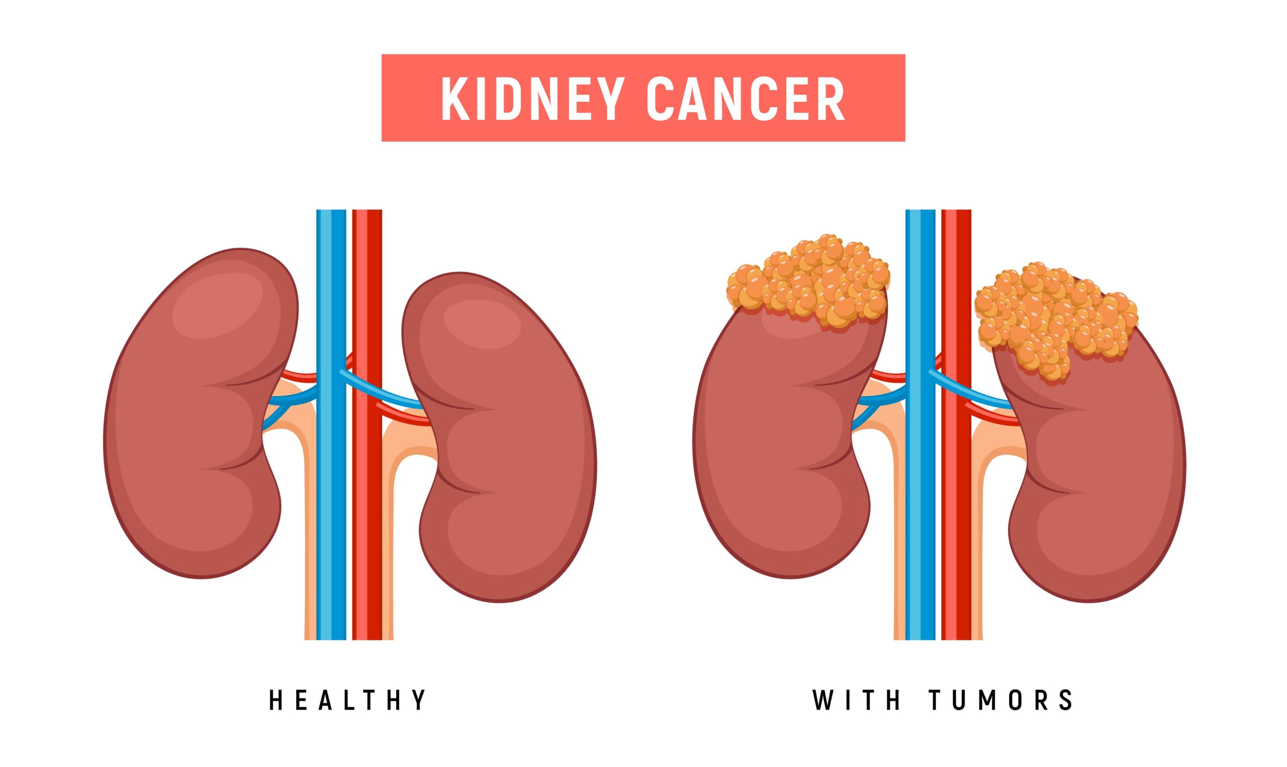 Kidney Cancer Treatment