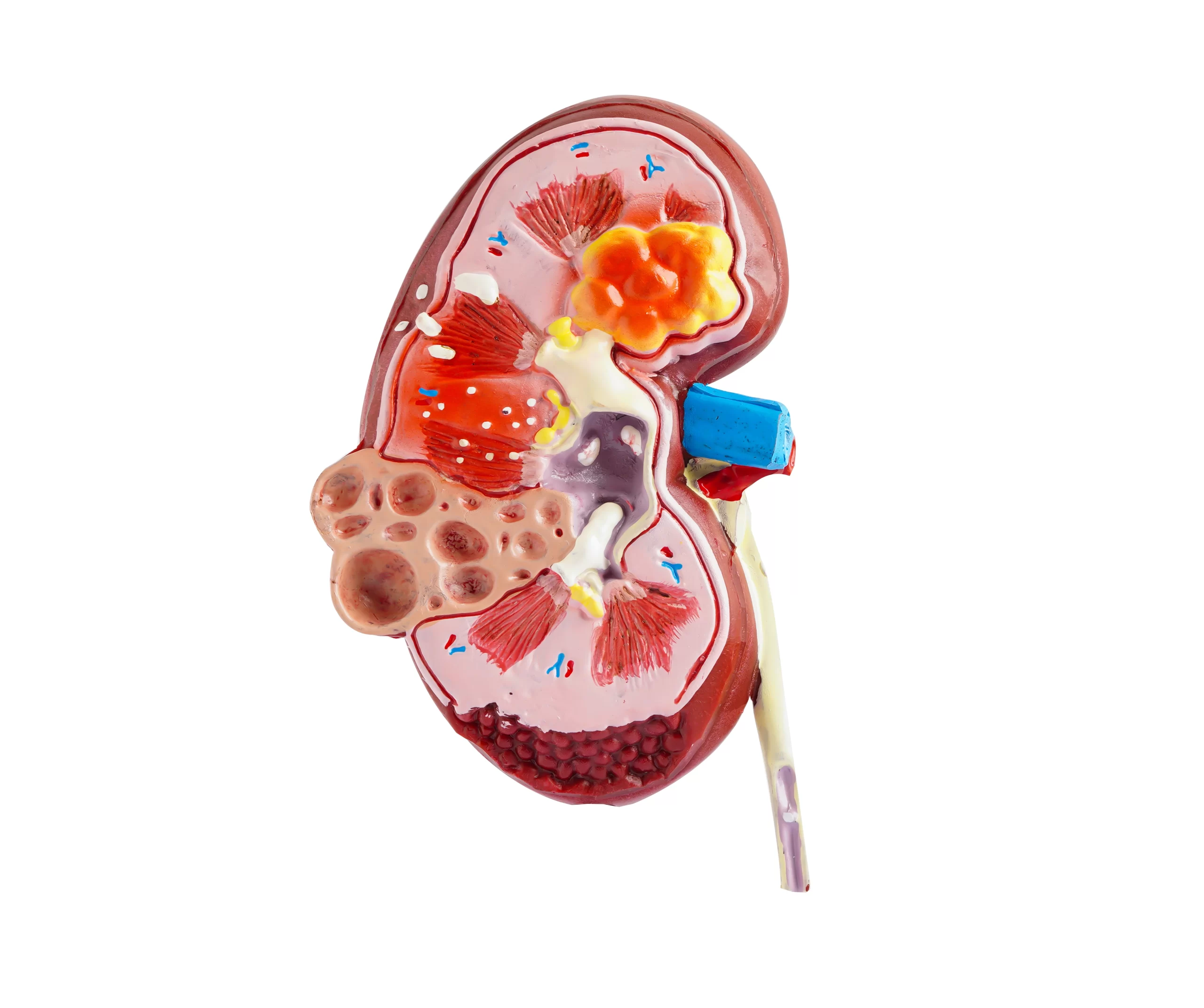 Renal Cell Carcinoma