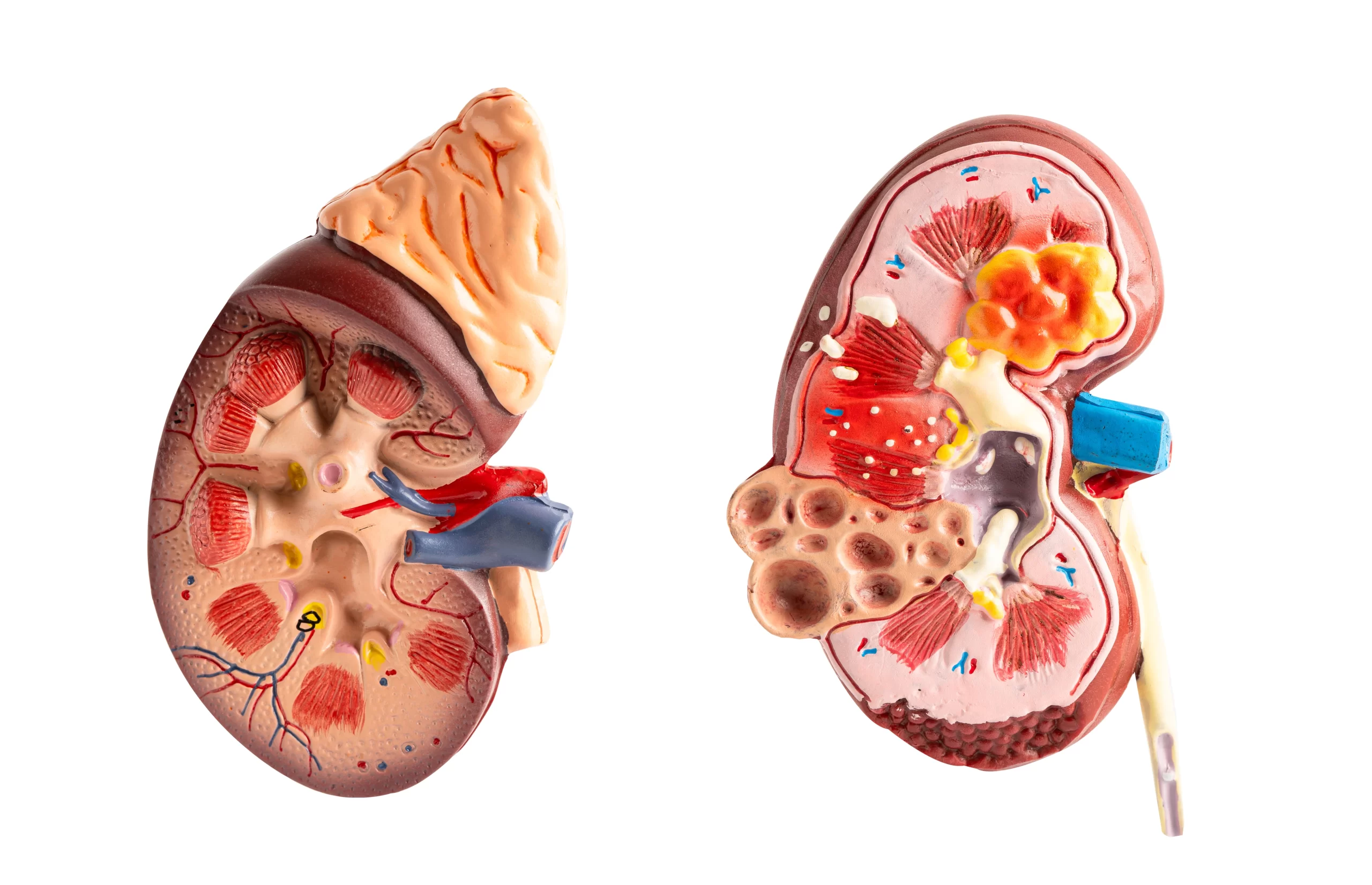 Chronic Kidney Disease
