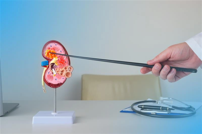 Kidney stones